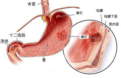 莆田胃病治療