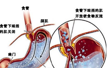 食管炎的較佳治療方法是什么